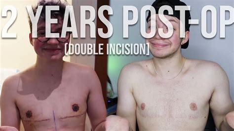 Two Years Post Op Top Surgery Double Incision Ftm Transition Youtube