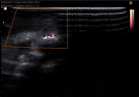 Chronic Hereditary Lymphedema Image