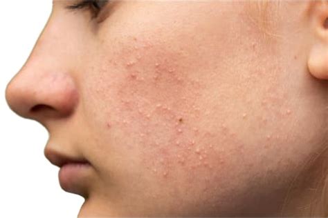 Causes Of Bumps On The Face Best Treatments From Derms