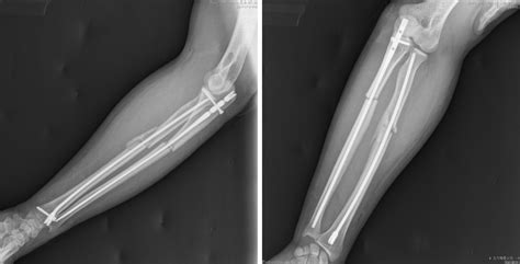 Ulna Fracture X Ray
