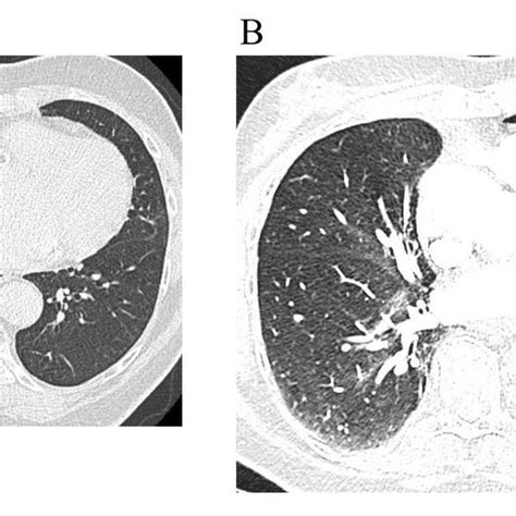 A Ct Scan Shows Focal Consolidation In The Subpleural Area Of The