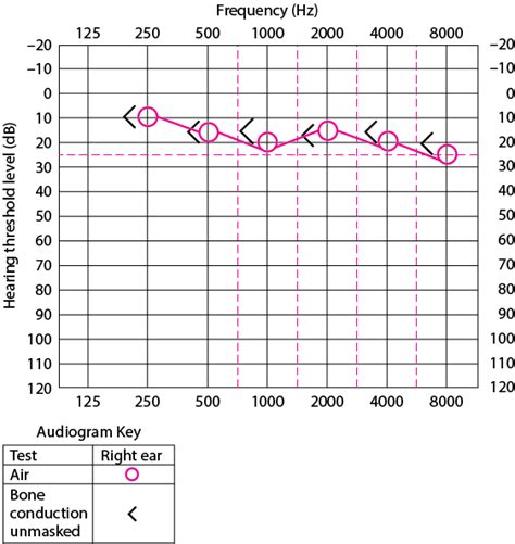 Table Audiogram Of Right Ear In A Patient With Normal Hearing Msd