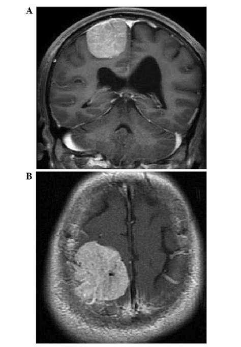 Microsurgical Treatment For Parasagittal Meningioma In The Central