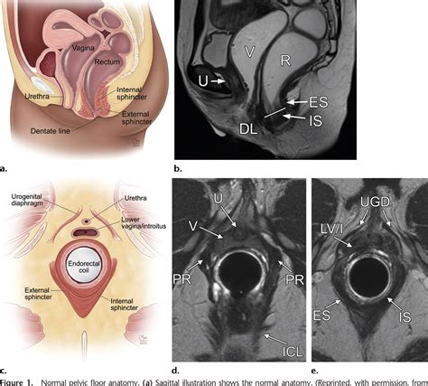 Figure From Imaging And Surgical Management Of Anorectal Vaginal