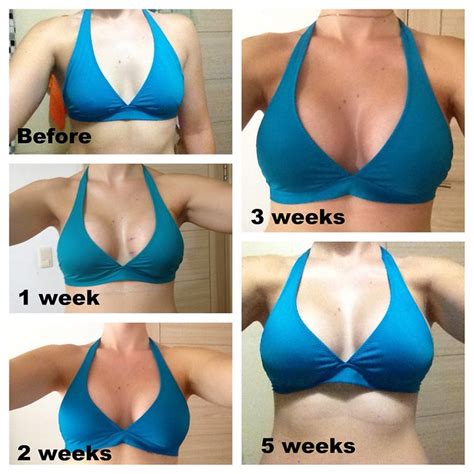Top Pictures Breast Implant Illness Before And After Sharp
