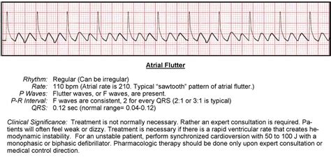 Atrial Flutter Litfl Ecg Library Diagnosis