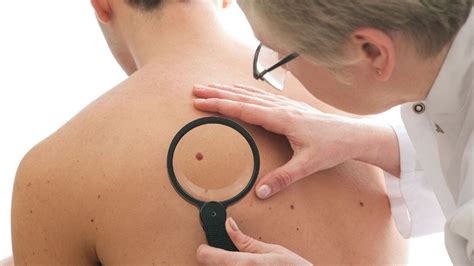 Mens Skin Cancer Deaths Are Higher Than Womens New Analysis Rodina News