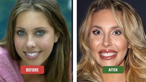 chloe lattanzi opened up about having plastic surgery chloe lattanzi before and after pictures