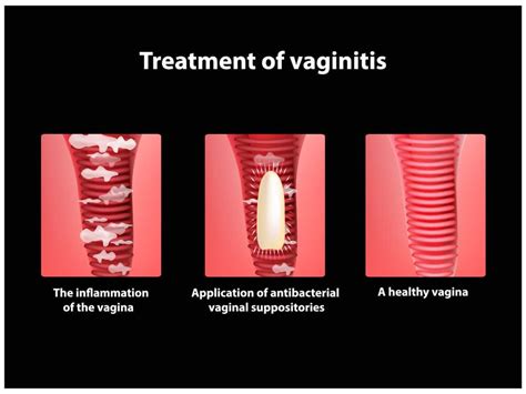 Vaginitis Gejala Penyebab Pengobatan Dll Hello Sehat