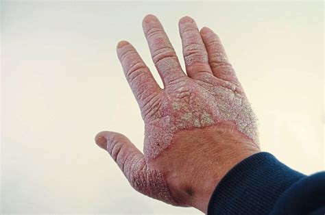 Thick Scaly Patches Appearing On Your Skin Its Psoriasis The Star