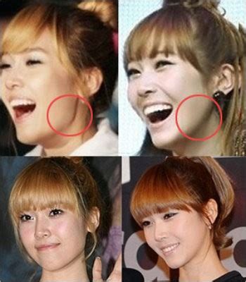 Contoh, pembedahan untuk mulut yang sumbing atau pembedahan untuk menampal kulit yang melecur. Blog Sana Sini: Jessica SNSD Pernah Buat Pembedahan Plastik?