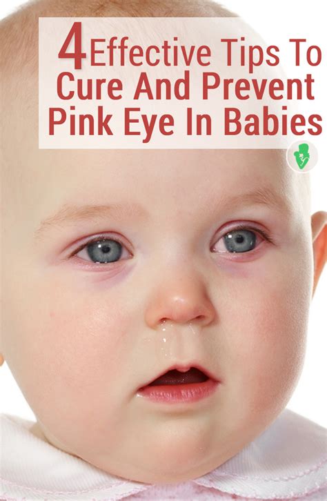 Babies Pink Eye Pictures Photos