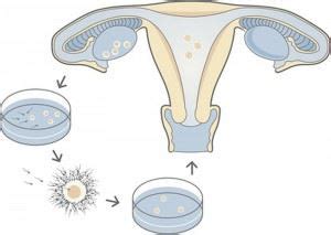 This process involves several steps which need to be. Infertility - Causes and Types of Solutions - IVF, ZIFT, GIFT
