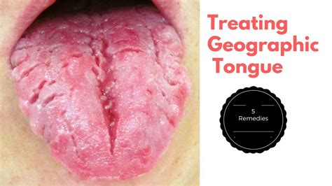Top 5 Home Remedies For Treating Geographic Tongue Youtube