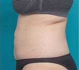 Fat Freezing Treatment Prices Pictures