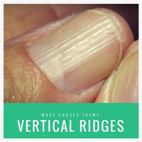 Review Of Causes Of White Vertical Lines In Fingernails Ideas Fsabd42