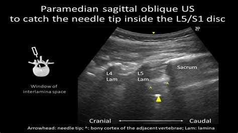 Us Guided Lumbar Intradiscal Injection For Discogenic Pain