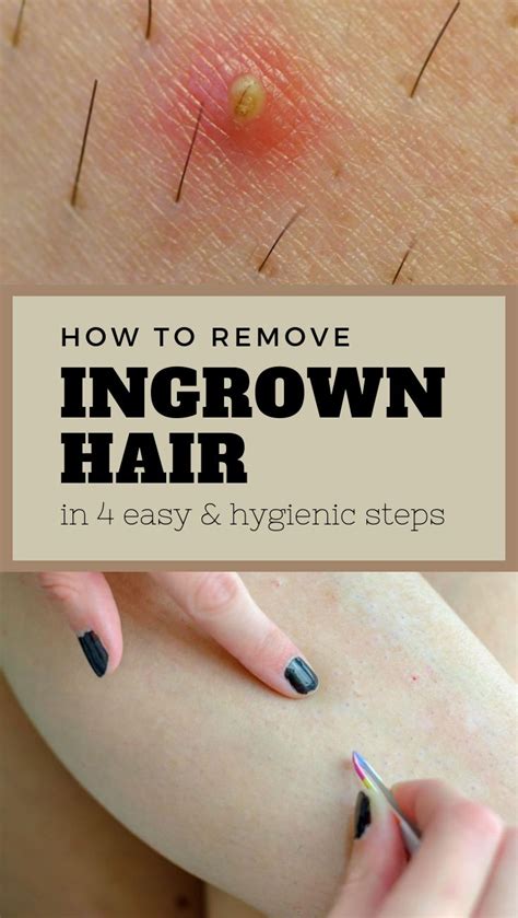How To Remove Ingrown Hair In Easy And Hygienic Steps Ingrown Hair Hygienic Ingrown Hair