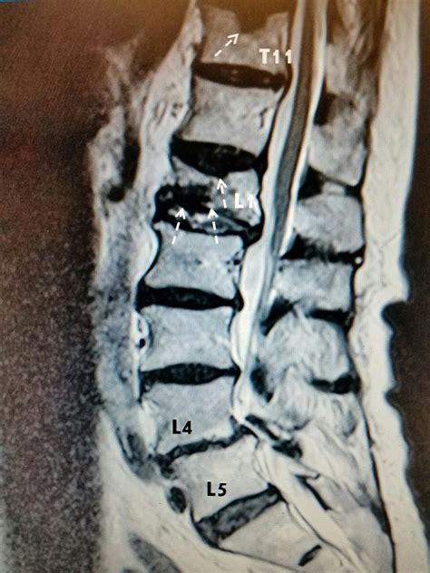 Cureus Delayed Recognition Of Thoracic And Lumbar Vertebral