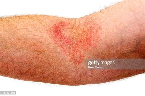 Red Rash Arm Foto E Immagini Stock Getty Images