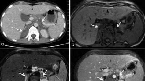 A Axial Contrast Enhanced Ct Image At The Level Of Adrenal Glands