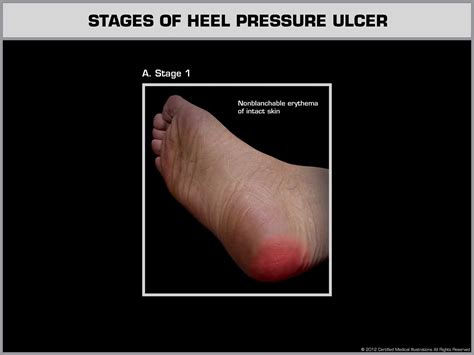 Pressure Ulcer Stages Pressure Ulcer Staging Pressure Ulcer Wound Hot