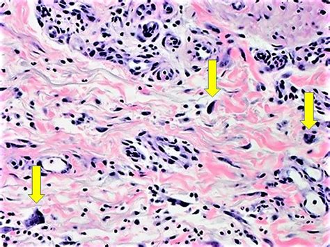 Multinucleate Cell Angiohistiocytoma Case Report And Literature Review