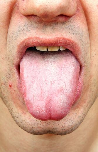 Bacterial Infection Disease Tongue Stock Photo Download Image Now