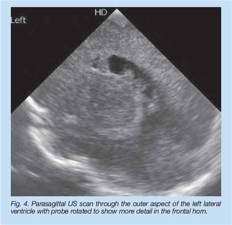 Figure 4 From Bilateral Periventricular Nodular Heterotopia Neonatal