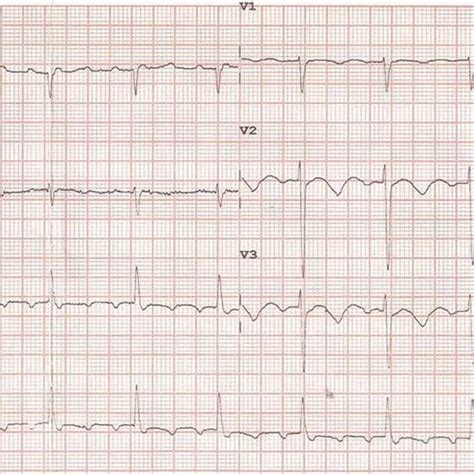 12 Lead Electrocardiogram Ecg Showed A Atrial Fibrillation With