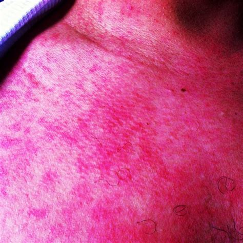Maculopapular Rash With Central Clearing Pope Francis To Visit