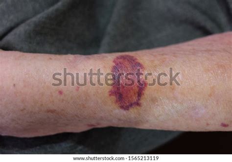 Senile Purpura On Arm Asian Elderly Photo De Stock Modifiable