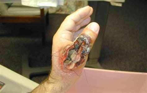 Brown Recluse Spider Bites Symptoms And Pictures 2022