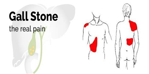 What Are The Different Treatment Options For Gall Bladder Stone Rg