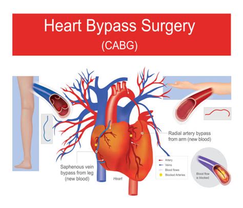 Heart Bypass Surgery Illustrations Royalty Free Vector Graphics And Clip