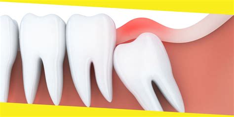 What Should You Do About A Wisdom Tooth Cavity