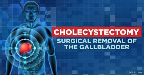 Cholecystectomy Surgical Removal Of The Gallbladder