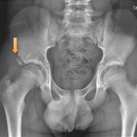 Anteroposterior Radiograph Of A Right Hip Anterior Inferior Iliac Spine