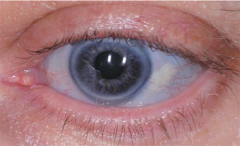 Blue Sclera Of Patient Download Scientific Diagram