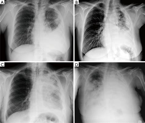 Clinical Diagnosis Of Malignant Pleural Mesothelioma Bianco Journal