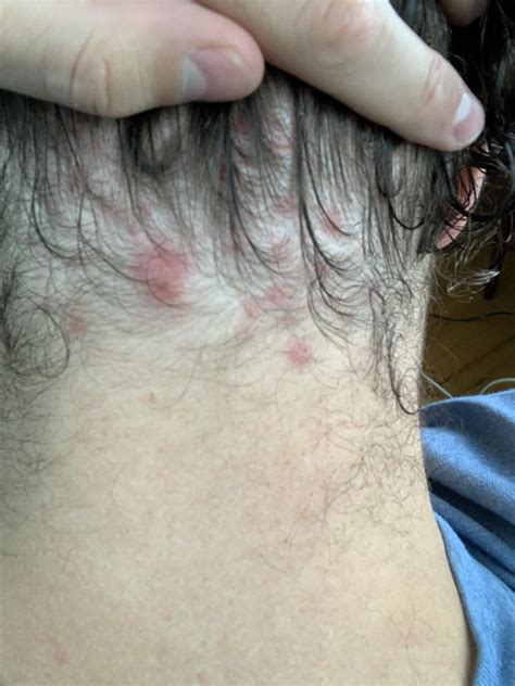 Whats The Deal With Back Of Neck Hairline Pimples What Could Cause