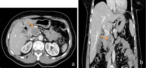 Axial A And Coronal B Sections Of Contrast Enhanced Ct Scan Of The