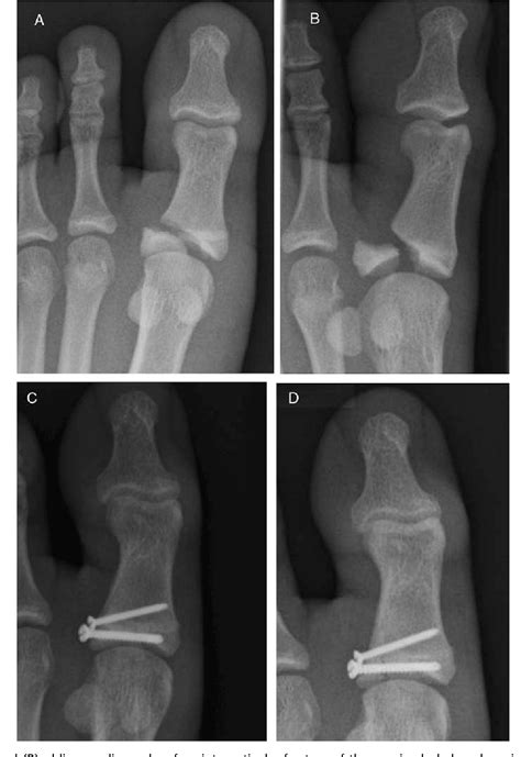 Displaced Intra Articular Fractures Of The Great Toe In Children