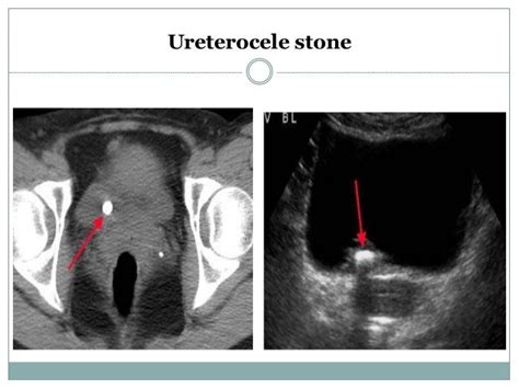 Ectopic Ureter And Ureterocoele