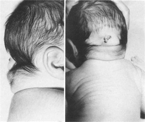 Cervico Occipital Teratoma In The Newborn Infant In Journal Of