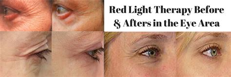 Red Light Therapy Reduce Wrinkles Age Spots Acne And More