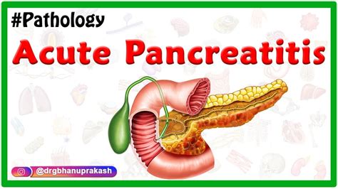 Acute Pancreatitis Etiology Signs And Symptoms Pathophysiology