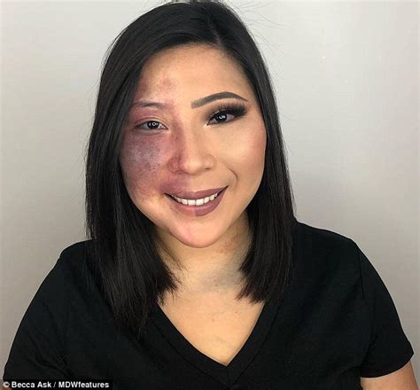 minnesota woman who hid her birthmarks shows off her natural face daily mail online