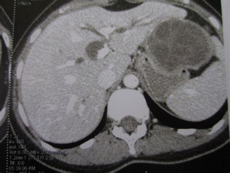 Ct Scan Showing Hepatic Hydatid Cyst With Dilatation Of Left Intra