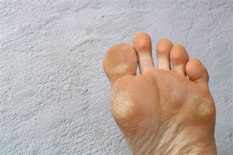 From Cracked Heel To Swelling What Do Your Feet Say About Your Health